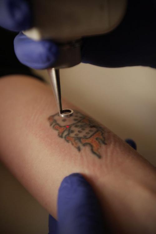 Ivan Skok, laser technician and owner of Tattoo Time Machine, removes a tattoo from Amber in his tattoo removal clinic in Winnipeg Thursday, August 4, 2011.  John Woods/Winnipeg Free Press
