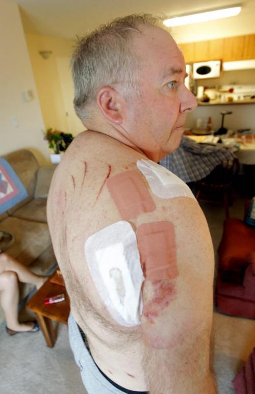 Gord Shurvell was attacked by a bear in NW Ontario. May 23, 2012  BORIS MINKEVICH / WINNIPEG FREE PRESS