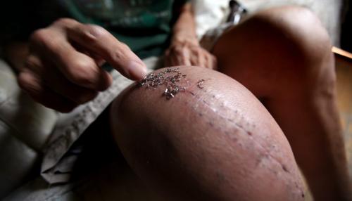 Bill DesJardin points to the 30 staples used to close the gaping incision made by surgeons at Concordia Hospital in Winnipeg to replace his right knee. September 6, 2012 -(Phil Hossack / Winnipeg Free Press)