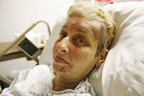 John Woods / Winnipeg Free Press / September 24, 2007 - 070924  - Mary Ewing, Winnipeg Free Press carrier, lies injured in her hospital bed Monday, September 24/07 suffering from leg and head injuries after the driver of a car swerved into her hitting her head-on early Saturday morning as she was starting her delivery route.