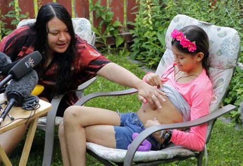 Right, Allexis Siebrecht is the 11-year-old liver transplant girl who got back to Winnipeg early Tuesday morning. The family held a press conference at their home in Windsor Park. Mother Liz Siebrecht spoke to media about their experience. Aidan Geary story. BORIS MINKEVICH/WINNIPEG FREE PRESS July 8, 2015