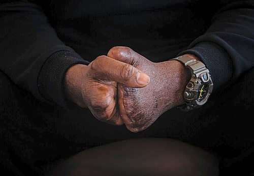 JESSICA LEE / WINNIPEG FREE PRESS

Abdul Razak Iyal, a man who lost his fingers crossing the border in 2017, poses for a photo at his Winnipeg home on February 25, 2022.

Reporter: Melissa
