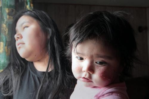 JOE.BRYKSA@FREEPRESS.MB.CA NO RUNNING WATER FEATURE-(See Helen's story)  -    Mother Larissa Harper with child Lyra with skin rash at Red Sucker Lake First Nation. In homes with no running water, it's difficult to keep children clean- - July 2010, - JOE BRYKSA/WINNIPEG FREE PRESS
